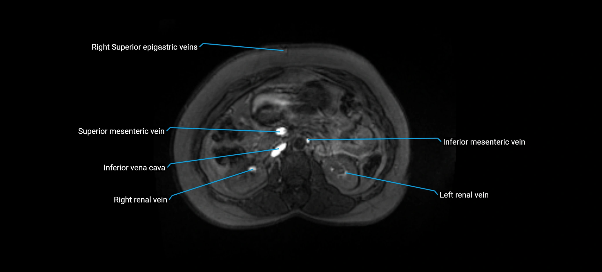 MRV abdomen pelvis & lower limb axial cross sectional anatomy labelled MRI image 72 (1).webp